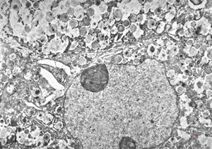 M,39y. | lymph node - metastasis of adenocarcinoma